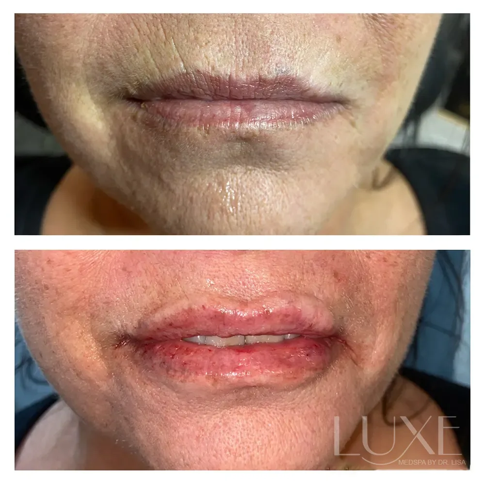 Photo of the patient’s face before and after the anti-wrinkle injections treatment. Patient 1 - Set 1