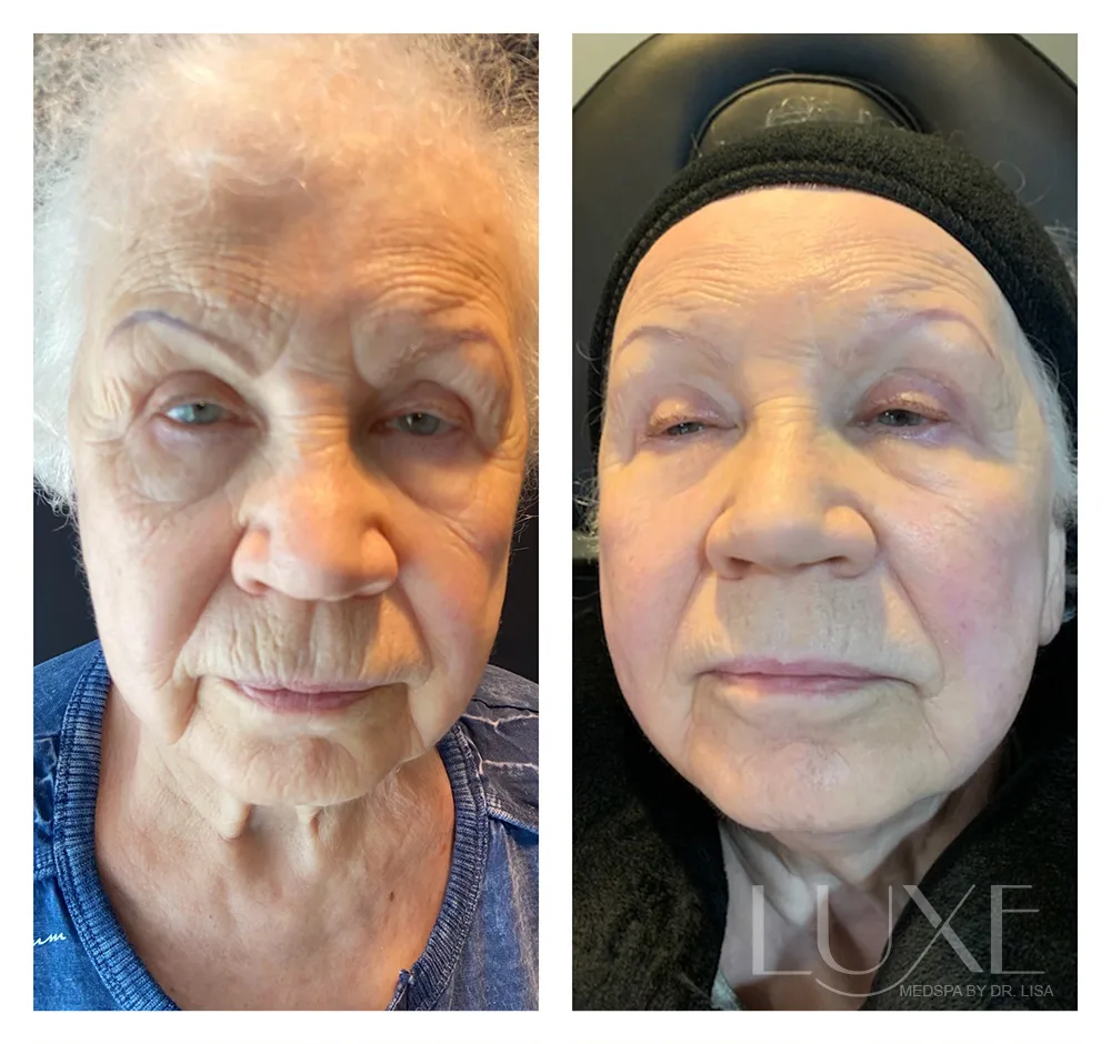Photo of the patient’s face before and after the Morpheus8 treatment. Patient 1 - Set 1