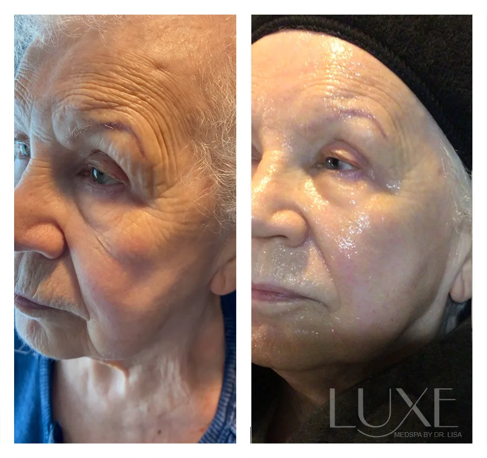 Photo of the patient’s face before and after the Morpheus8 treatment. Patient 1 - Set 2