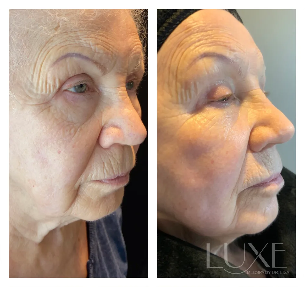 Photo of the patient’s face before and after the Morpheus8 treatment. Patient 1 - Set 3