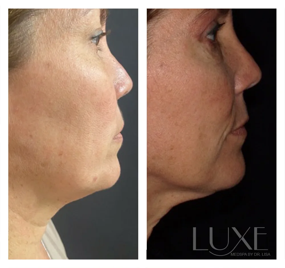 Photo of the patient’s face before and after the Neck Contouring. Patient 5 - Set 1