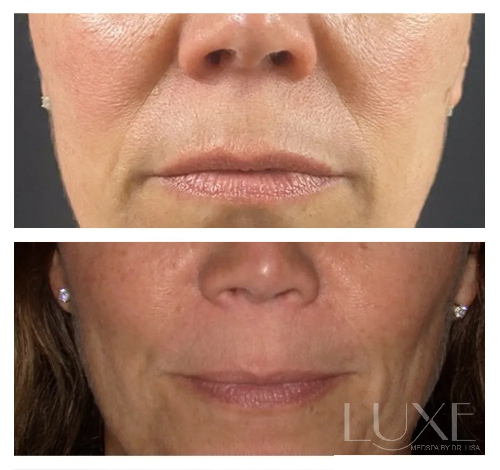 Photo of the patient’s face before and after the Neck Contouring. Patient 6 - Set 1