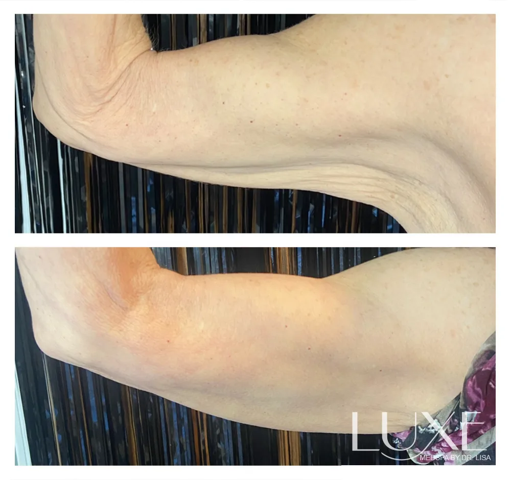 Photo of the patient’s hand before and after the Evolve treatment. Patient 2 - Set 1
