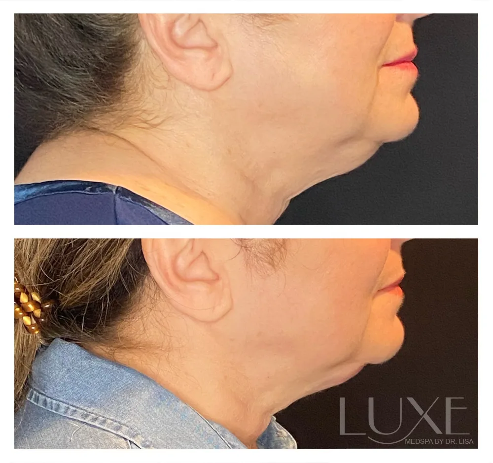 Photo of the patient’s face before and after the Neck Contouring. Patient 4 - Set 1