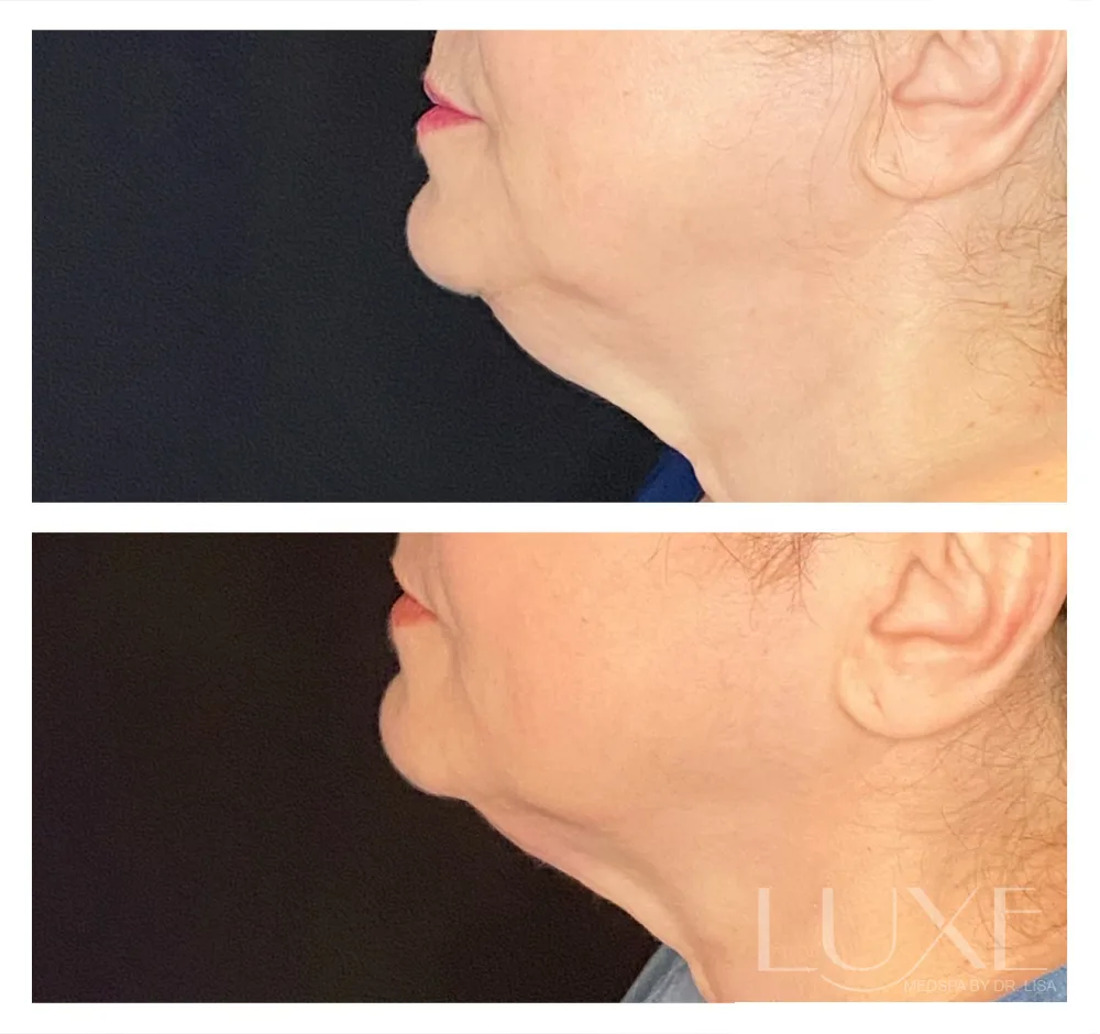 Photo of the patient’s face before and after the Neck Contouring. Patient 1 - Set 1