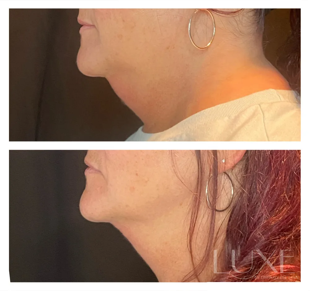 Photo of the patient’s face before and after the Neck Contouring. Patient 2 - Set 1