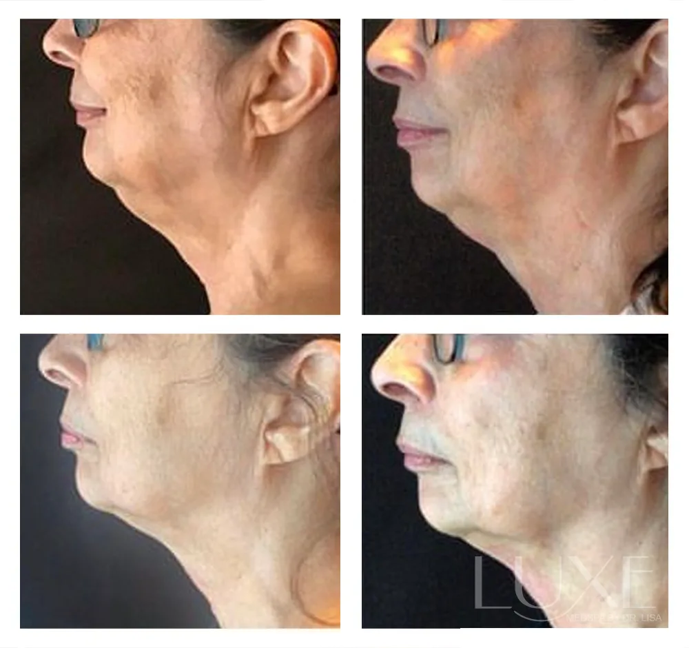 Photo of the patient’s face before and after the Neck Contouring. Patient 3 - Set 1